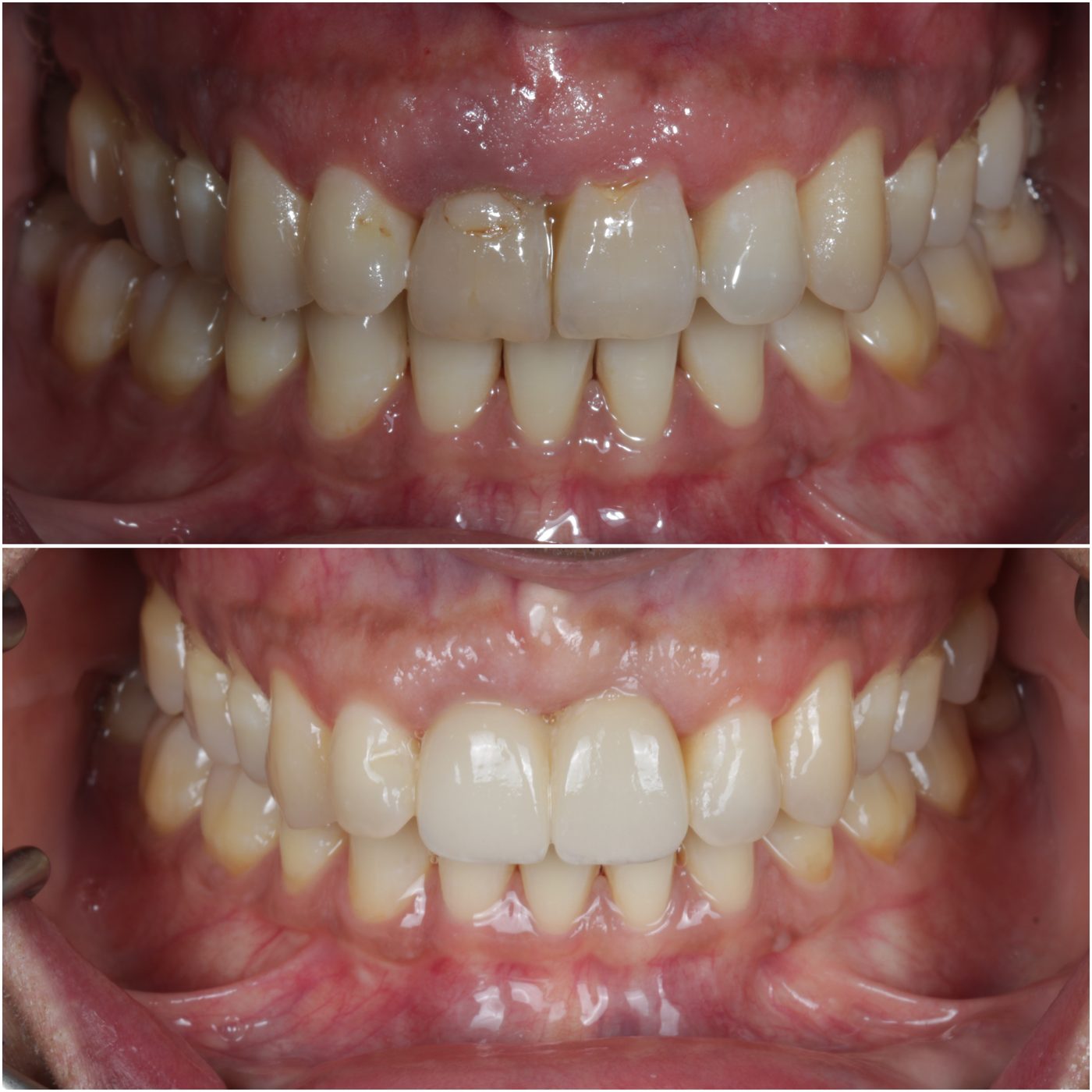 Anterior maxilla immediate implant case
