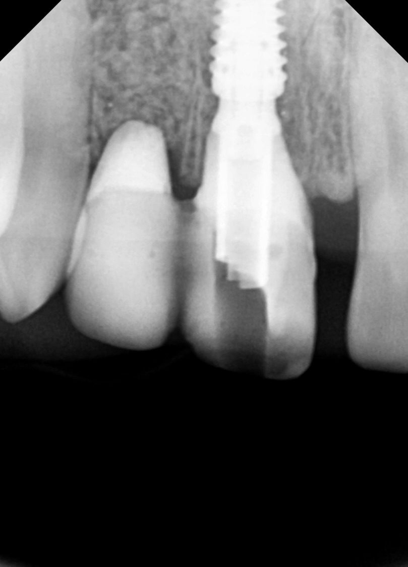 Provisional loading radiograph