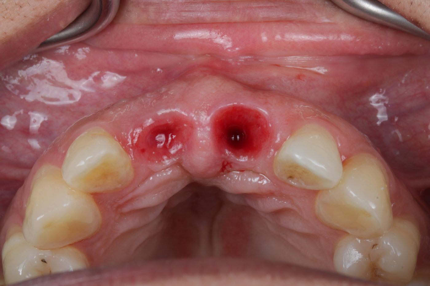 Soft tissue management at anterior extraction sockets