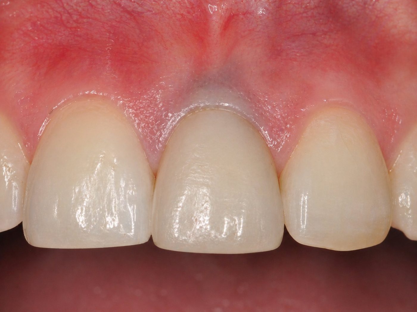 Gray show-through complication case