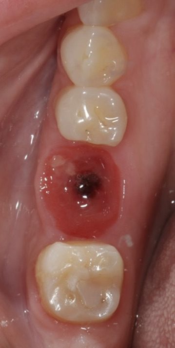 Molar immediate implant site with soft tissue healing